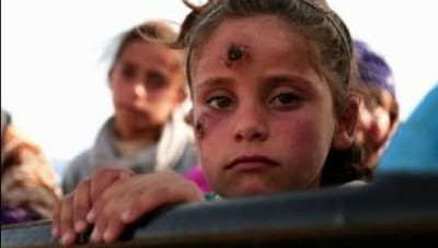 Thousands of injuries... Leishmaniasis invades Al-Hasaka countryside